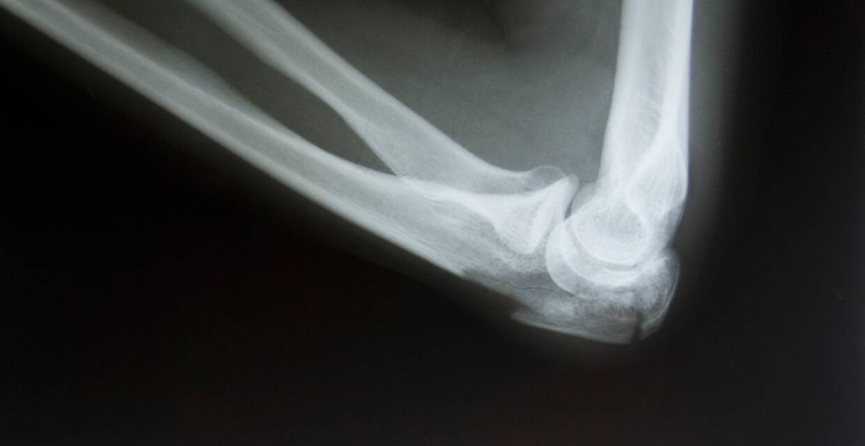 Bone Injuries: How to Know What You're Dealing With