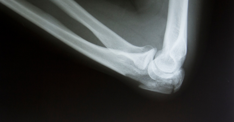 Bone Injuries: How to Know What You're Dealing With