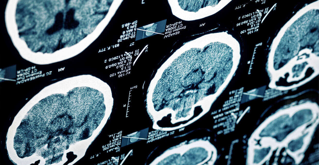 6 Signs of a Stroke (and What to Do If It Is)