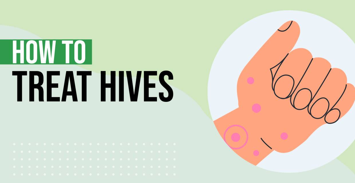 How to Treat Hives: 7 Home Remedies