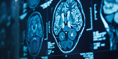 Brain Stroke: Symptoms, Causes, Treatments and Prevention