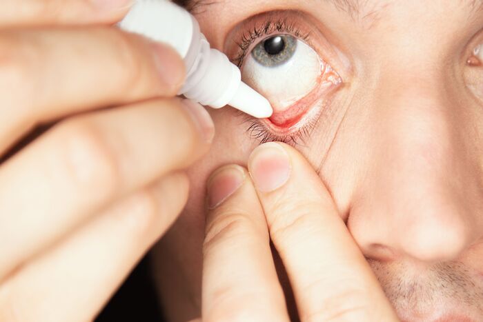 What Are Eye Allergies? Symptoms, Causes, and Treatment