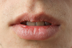 What is Dry Mouth? (Xerostomia) Symptoms & Causes