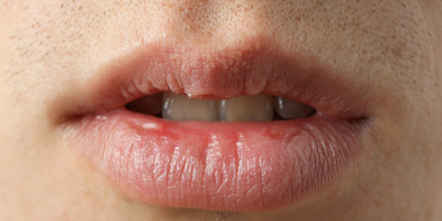 What is Dry Mouth? (Xerostomia) Symptoms & Causes