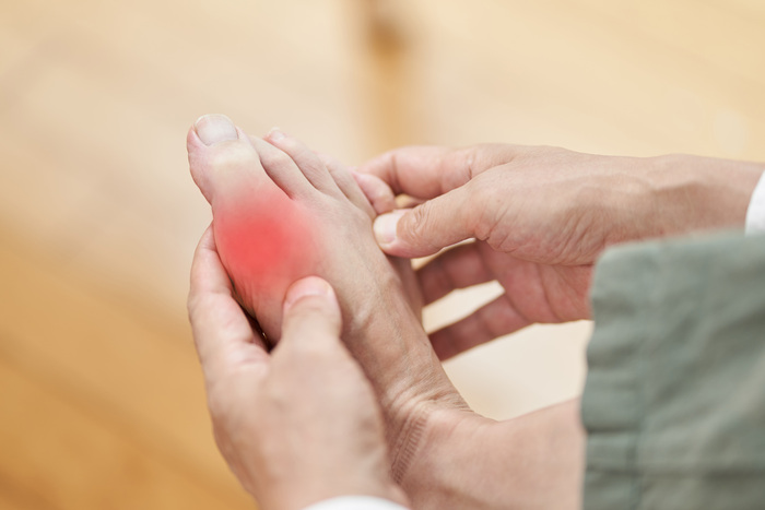 Gout: Tests, Treatment and Diagnosis