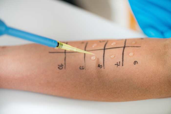 Allergy Testing Basics: Purpose, Types and Meaning