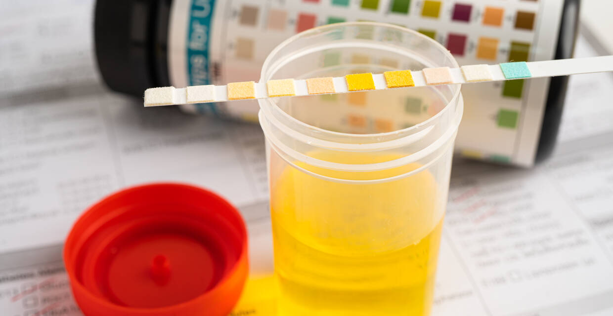 Glucose in Urine: Symptoms, Test, Causes & Treatment