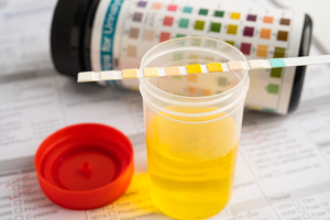 Glucose in Urine: Symptoms, Test, Causes & Treatment