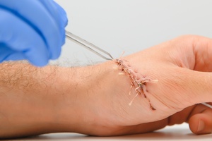 Infected Stitches: Symptoms & When Should You See a Doctor?