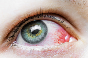 Viral vs Bacterial Pink Eye: Understanding Conjunctivitis