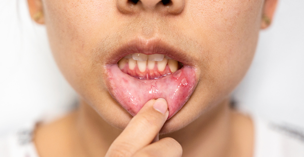 Oral Herpes: Symptoms & When to See a Doctor