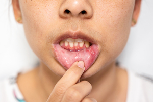 Oral Herpes: Symptoms & When to See a Doctor