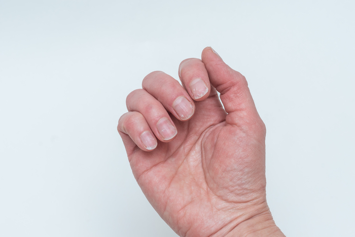 Onycholysis: When your nail lifts from the nail bed
